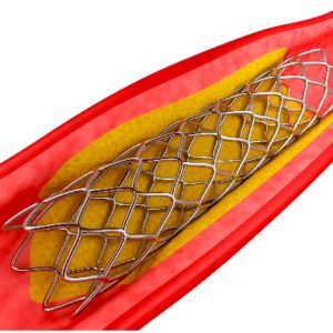 Life-saving coronary stents have been made affordable
